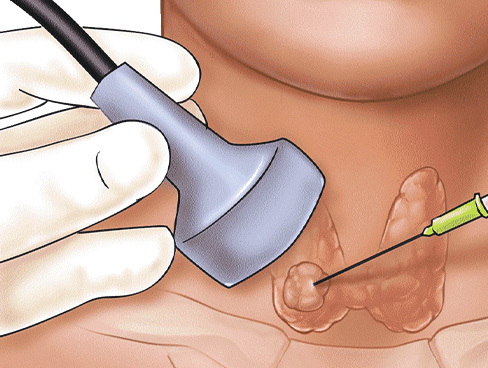 Tiroid Biyopsisi & Tiroid ROSE biyopsi Nedir?